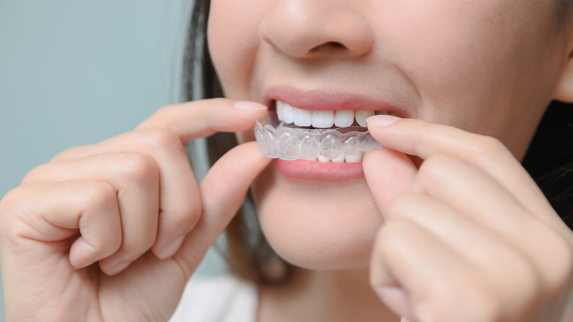 Woman putting on aligner braces